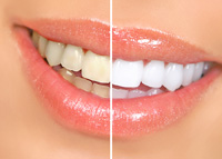 Teeth Whitening | Dentist In Midtown, Manhattan, NY | Scott C. Province, DDS